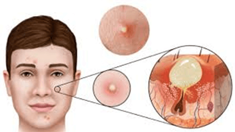 Trắc nghiệm Khoa học lớp 5 Kết nối tri thức Bài 25 (có đáp án): Chăm sóc sức khoẻ tuổi dậy thì