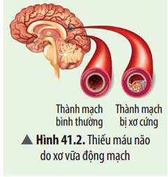 Nếu các thành mạch dẫn máu lưu thông lên não bị xơ cứng (Hình 41.2)