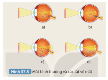Quan sát Hình 37.5 xác định mắt bình thường và mắt mắc các tật trong hình