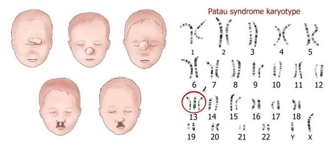 Lý thuyết KHTN 9 Chân trời sáng tạo Bài 41: Cấu trúc nhiễm sắc thể và đột biến nhiễm sắc thể (ảnh 16)