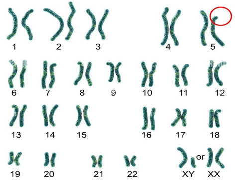 Lý thuyết KHTN 9 Chân trời sáng tạo Bài 44: Di truyền học với con người (ảnh 4)