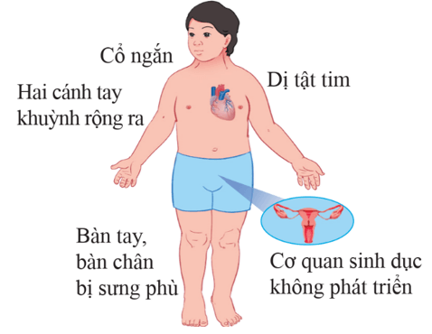 Lý thuyết KHTN 9 Chân trời sáng tạo Bài 44: Di truyền học với con người (ảnh 6)