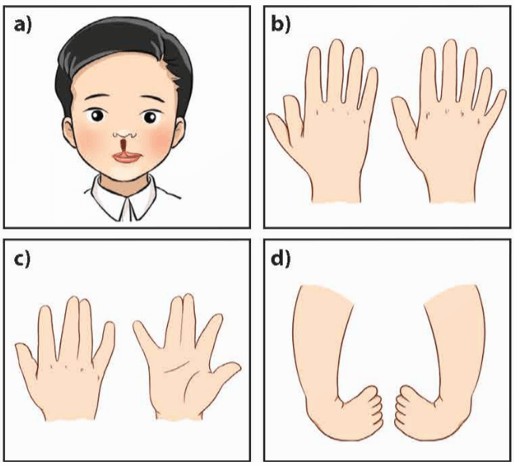 Lý thuyết KHTN 9 Chân trời sáng tạo Bài 44: Di truyền học với con người (ảnh 10)