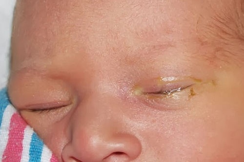 Làm gì khi mắt trẻ sơ sinh nhiều nghèn vàng