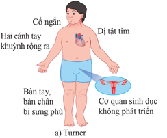 Người bị hội chứng Turner có biểu hiện trang 101 Sách bài tập Khoa học tự nhiên 9