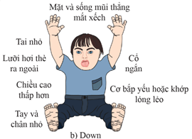 Người bị hội chứng Down có biểu hiện trang 101 Sách bài tập Khoa học tự nhiên 9