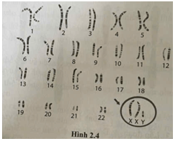 Hình 2.4 mô tả bộ nhiễm sắc thể của người mắc hội chứng nào